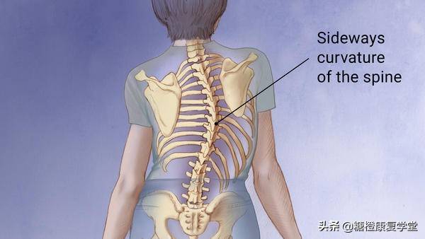骨盆侧倾与脊柱侧弯还有这种联系?(二)