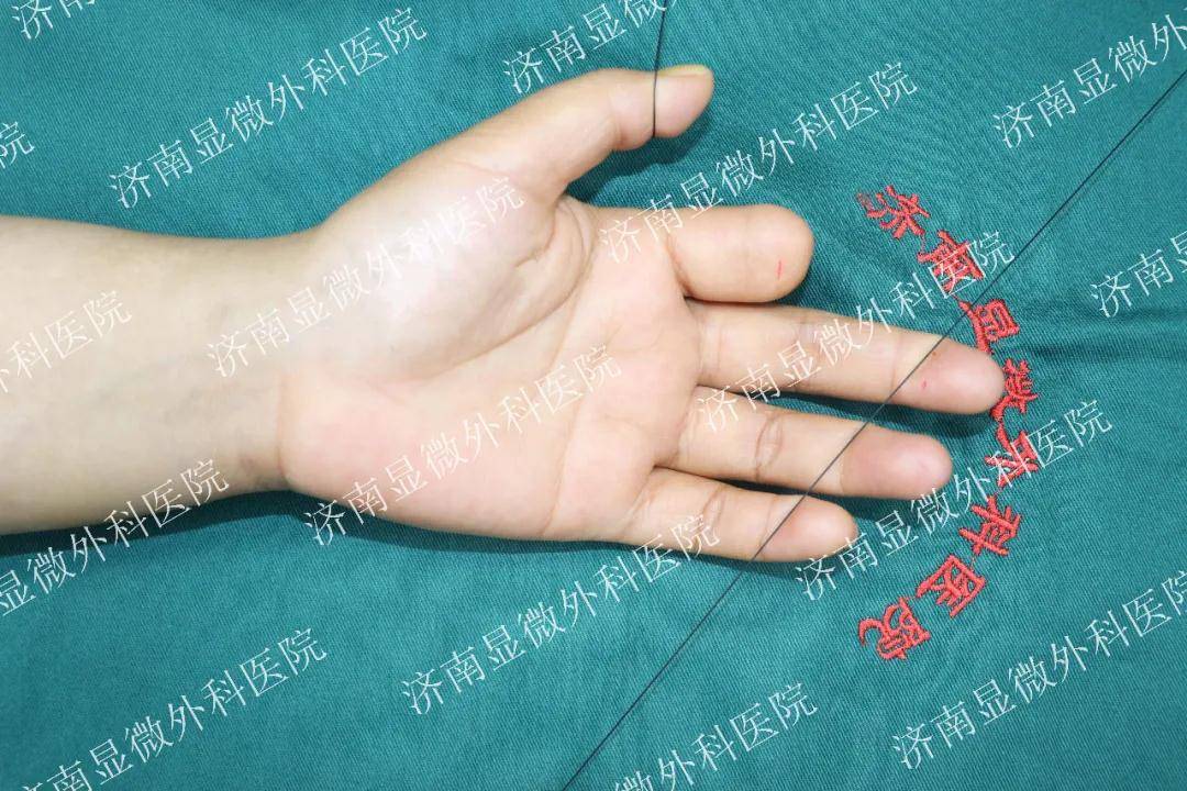 【真实案例】意外断指30多年,手指再造术给予患者希望