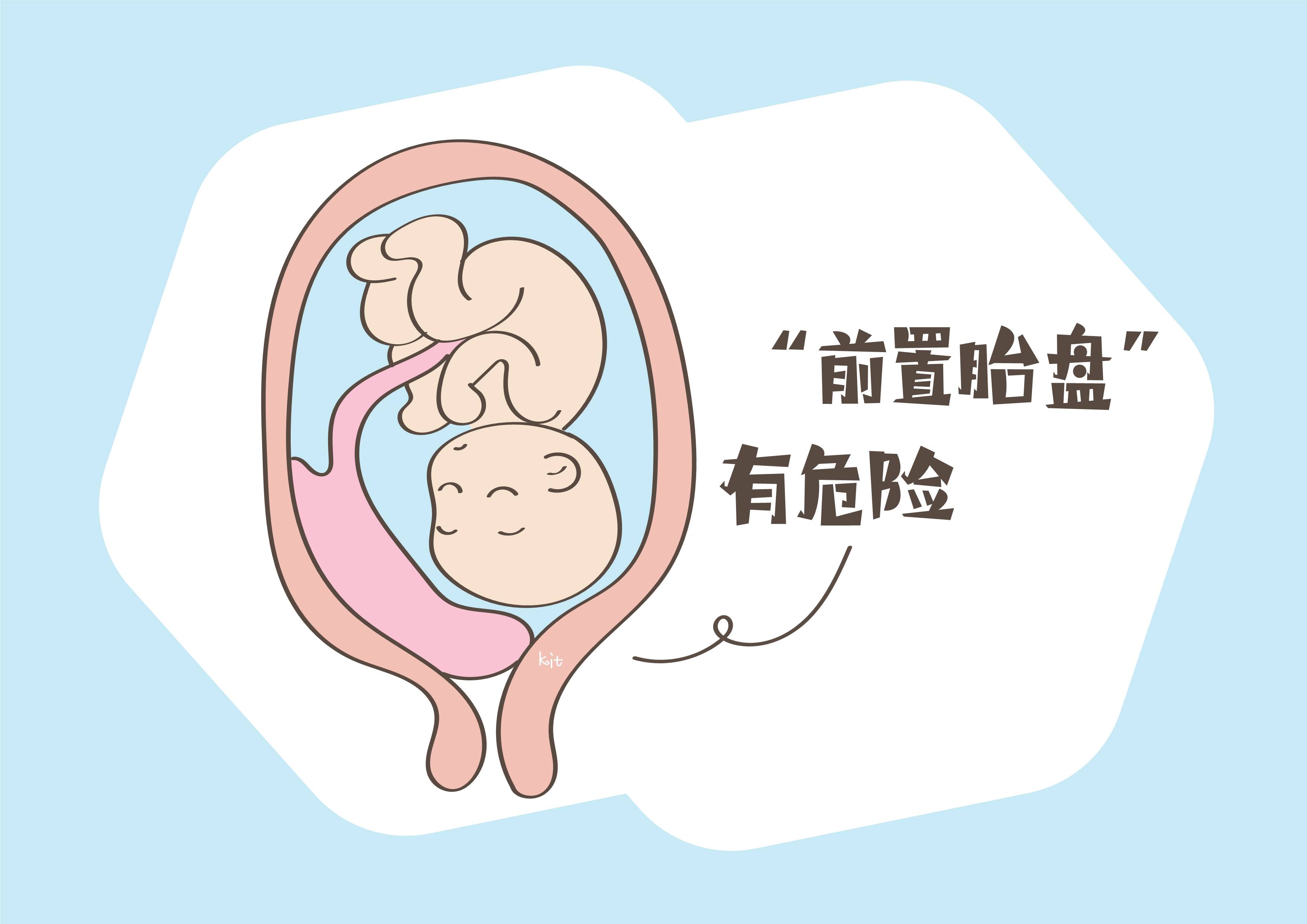 原创检出前置胎盘危险孕妈要警惕3种行为可有效预防问题发生