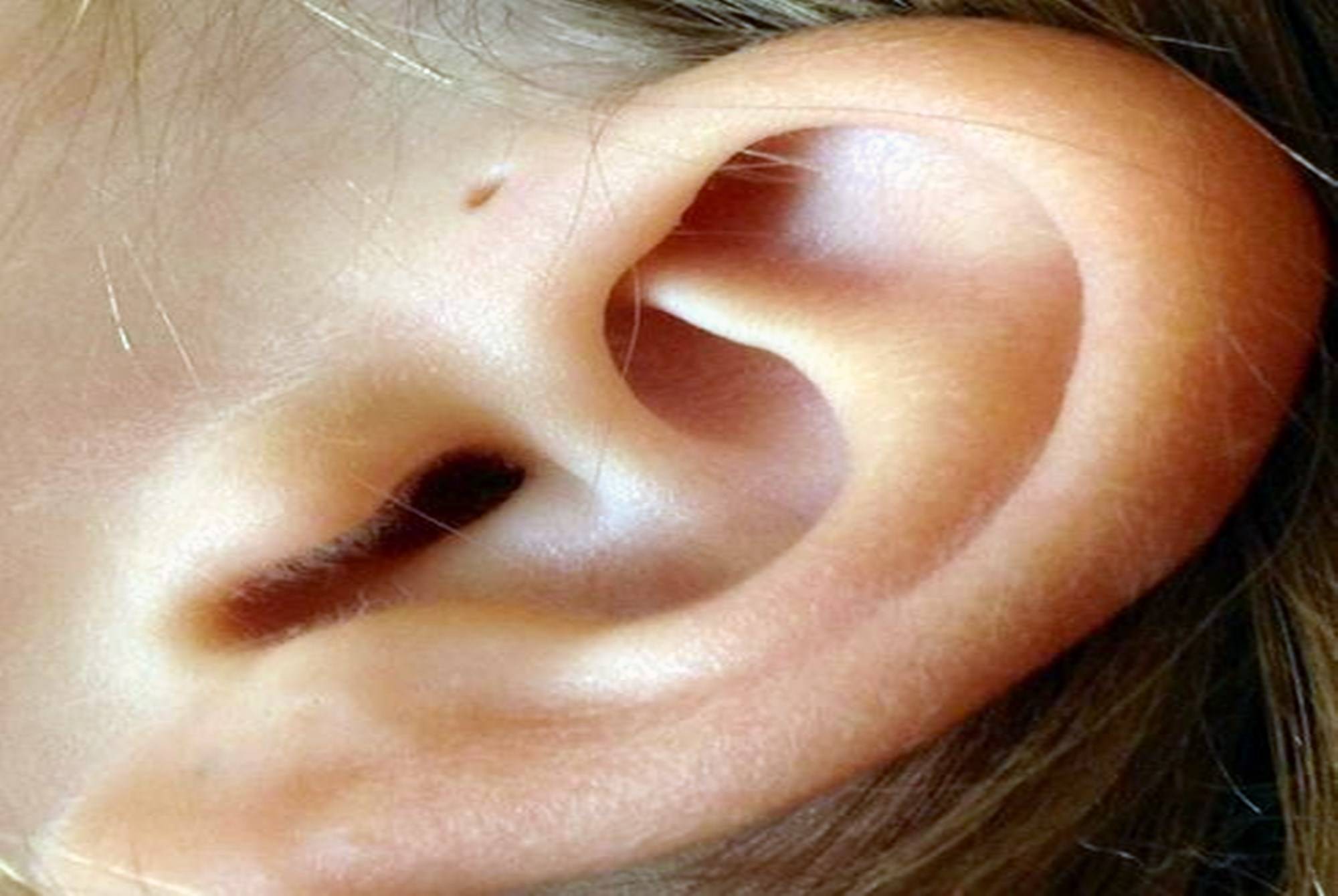 原创为啥有些新生儿耳朵上有小孔不是聪明孔可能暗示孩子危险