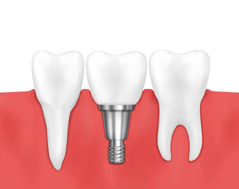 大连齿医生口腔科普 种植牙的这些误区你了解吗?