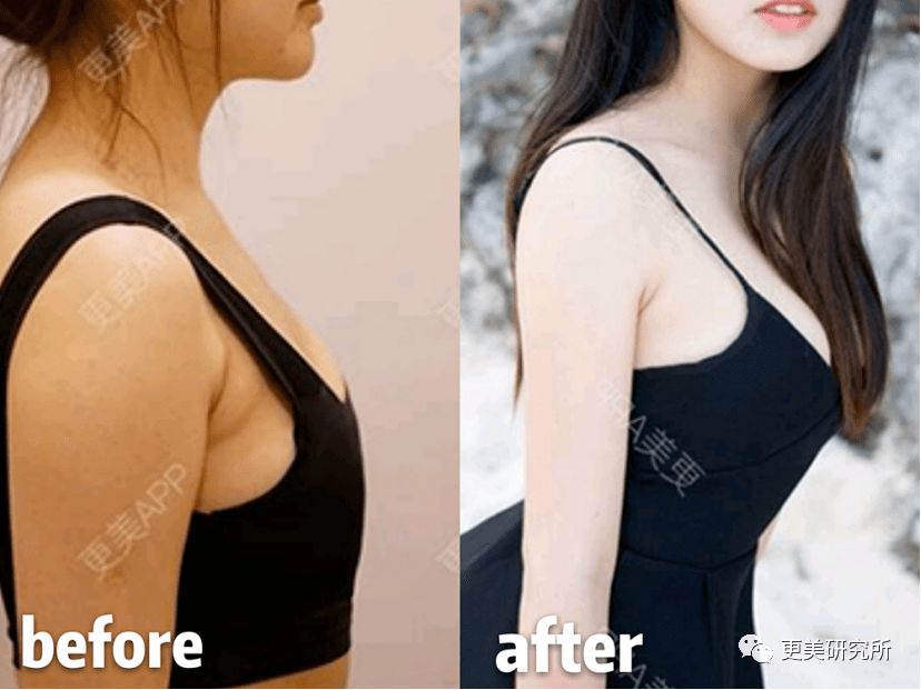 脂肪|鞠婧祎再花70w能do成迪丽热巴的前凸后翘？！