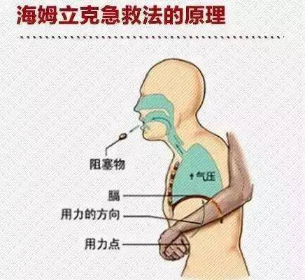 米饭卡到气管里怎么办