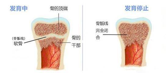 孩子|自卑小伙去国外“断骨增高”！结果面临终身残疾为长到1米8