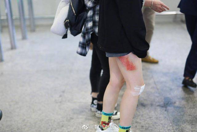伤痕|黄龄摔倒后首现身，腿蒙着纱布伤痕明显，网友：这看上去就好痛啊