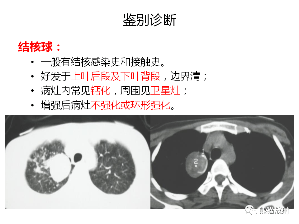 肺炎性假瘤