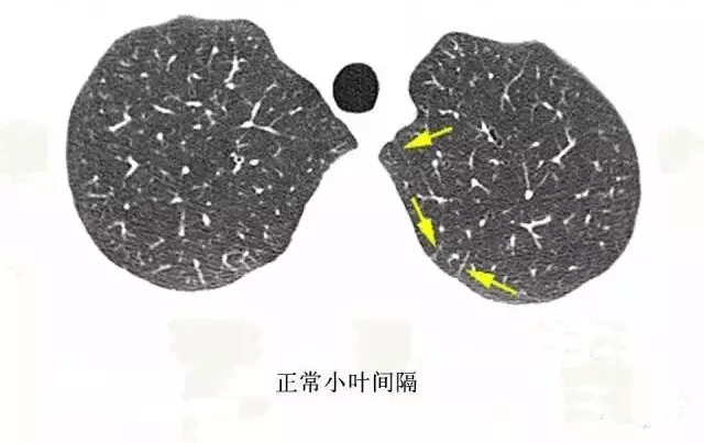 必看:肺气肿ct分型