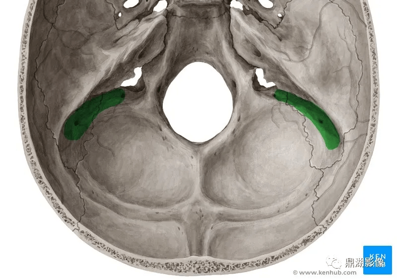 jugular bulb:颈静脉球 sigmoid sinus:乙状窦 transverse sinus:横窦