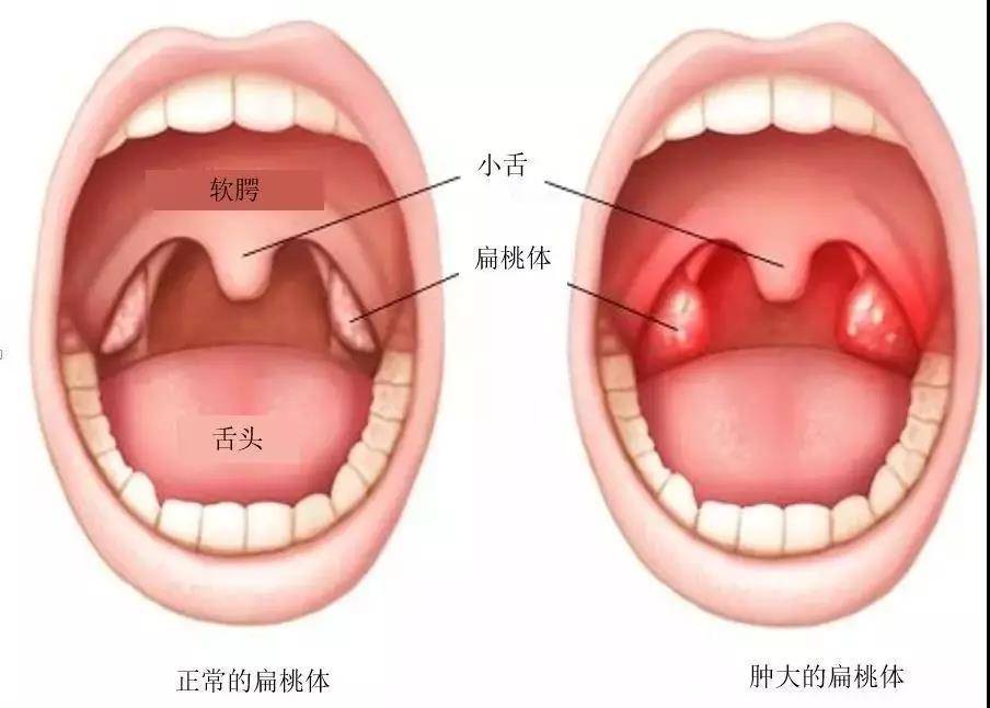 打鼾,让孩子越长越丑,越笨?口腔医生:真的,别不当回事