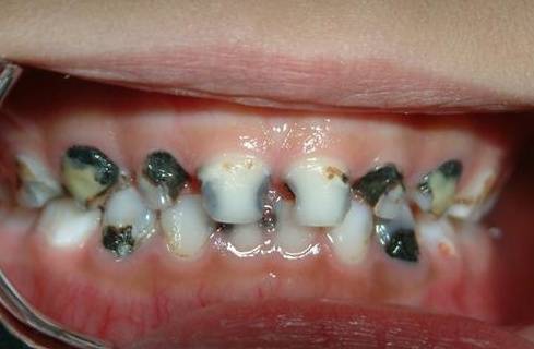 如果蛀牙在牙齿表面的话,还会影响人的外貌,导致孩子被嘲笑.