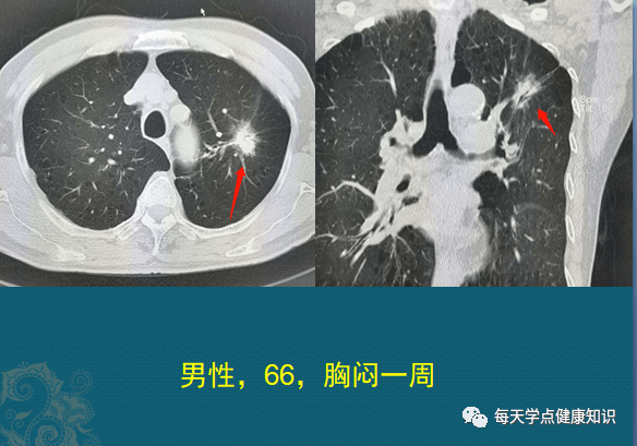 肺部硬结灶怎么办