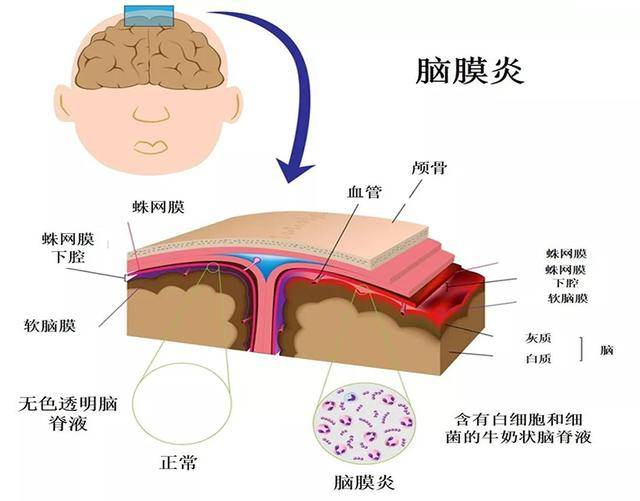 孩子|孩子严重脑损伤,该如何区分呢?因父母错把脑膜炎当成感冒