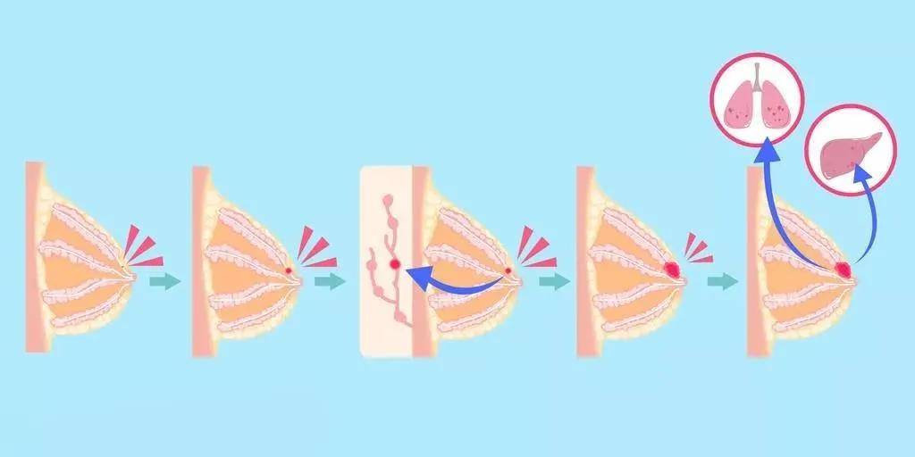 乳腺癌防治月|"乳"此脆弱,关爱迫在眉睫!_乳头