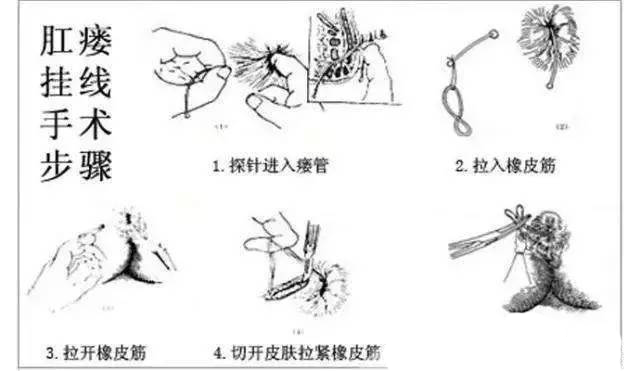 3,肛瘘切除术将创面的瘘管切开,然后切除创面至健康组织,创面不直接