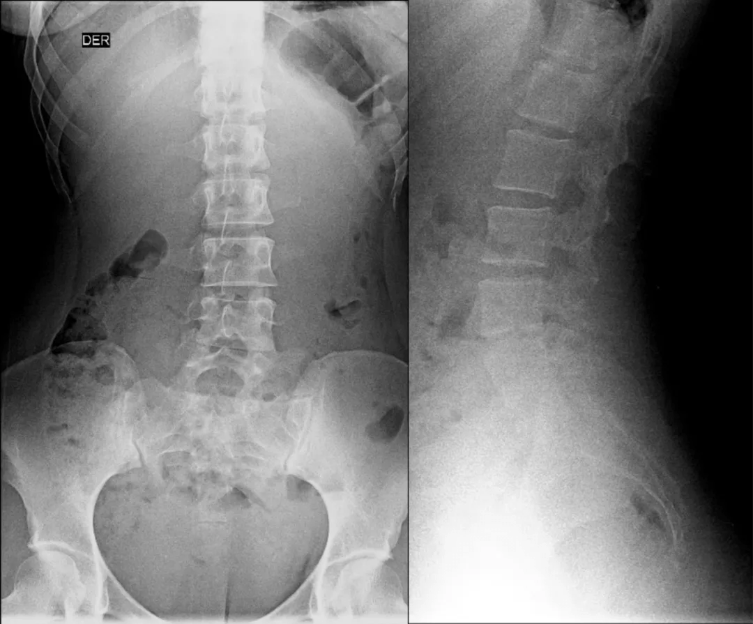 腰椎 x 线片示:l5 左侧横突肥大,间隙变窄,假关节形成,为 Ⅱa 型