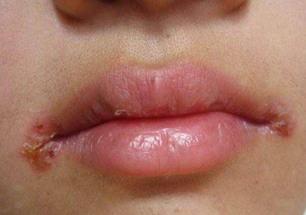 异常3:唇舌肥厚