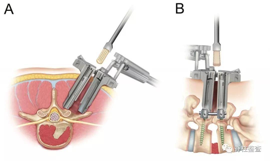如何选择丨腰椎间盘突出症该做微创手术还是开放性手术?