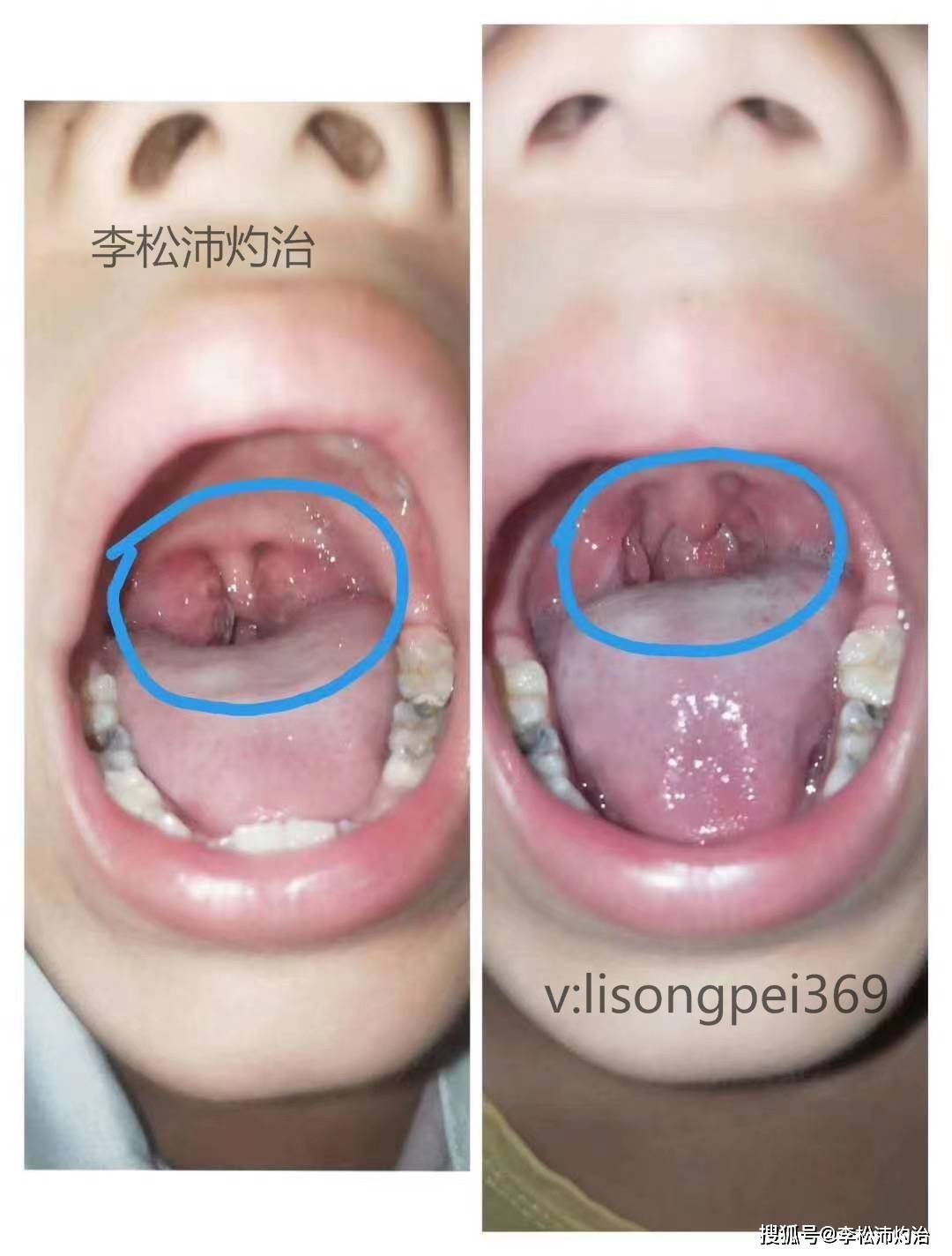 扁桃体肥大灼烙技术可以吗?扁桃体肥大灼烙技术原理!