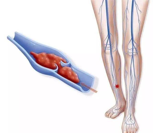 不管血栓在小腿静脉,还是蔓延至大腿静脉,甚至是大腿根部静脉,50~60%