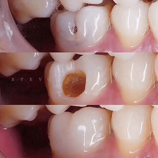 大连齿医生口腔科普 牙齿烂了一半,为什么不能补牙?