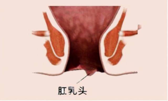 反复脱肛,肛门有异物感,当心肛乳头瘤