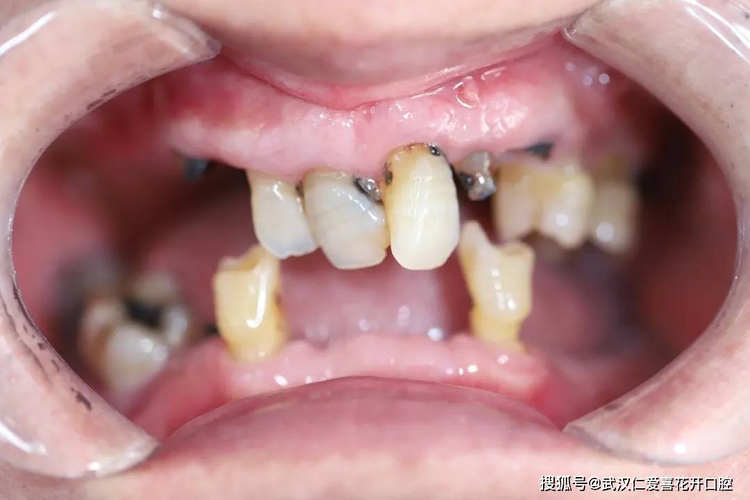 种植案例全口种植解决牙齿缺失