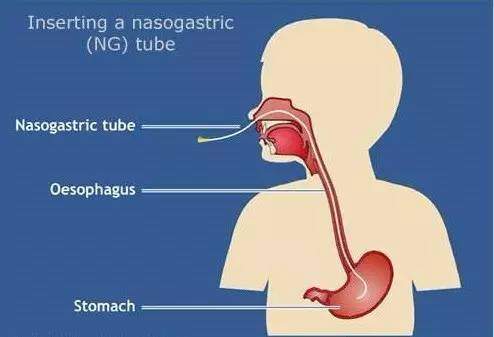 插胃管,是一项在临床看护中常用的操作技术,适用于一些无法自行进食