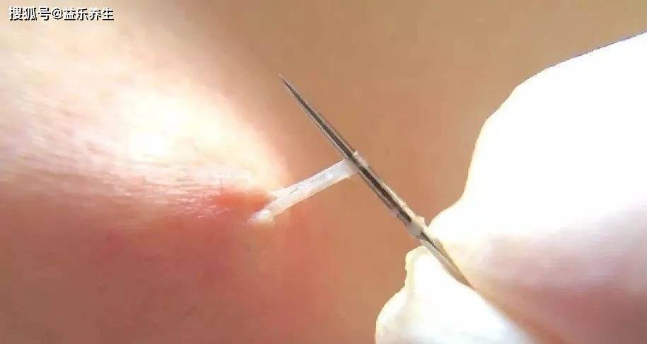 羊毛疔的症状及特点