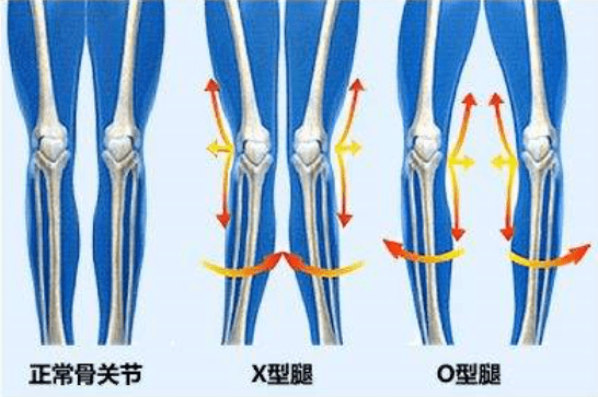 手术|杨幂关晓彤杠上了？撞衫尴尬就算了，还被网友喷做了直腿手术…