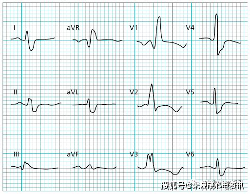 带你了解常见心肌病的心电图表现