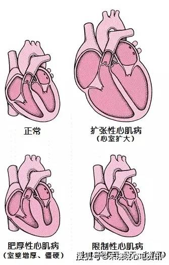 机械和电活动的异常,表现为心室不适当的肥厚或扩张,如心室扩张或肥厚