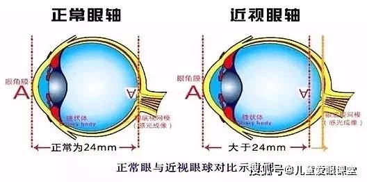 近视除了要验光配镜,为什么还要测眼轴?