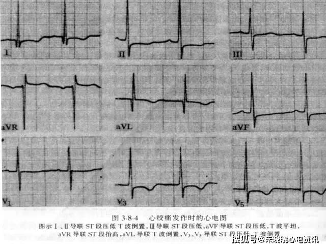 五,诊断慢性冠状动脉供血不足心电图的辅助试验