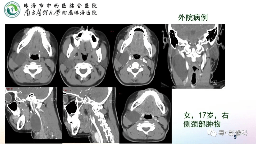 腮裂囊肿的ct表现知识总结