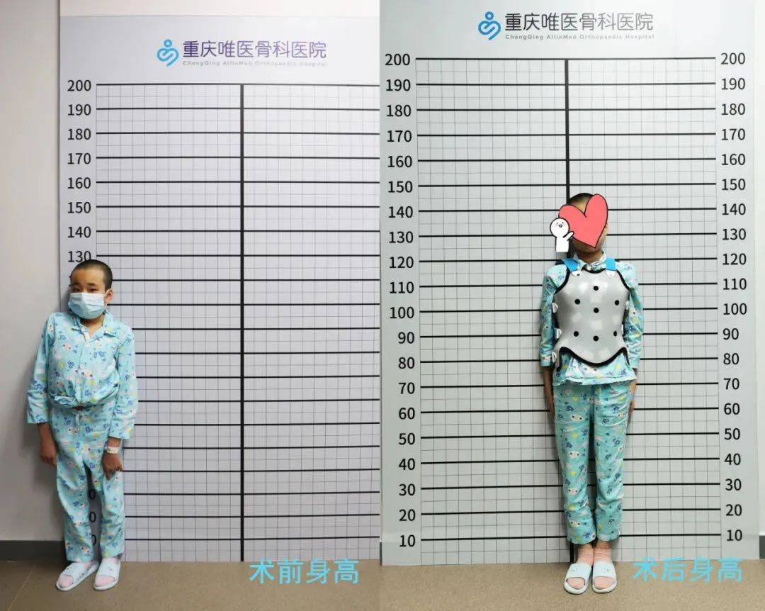 300万人中招每年30万增长脊柱侧弯到底是种什么病