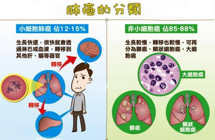 治疗肺癌的方法,非小细胞肺癌治疗选择包括哪些?