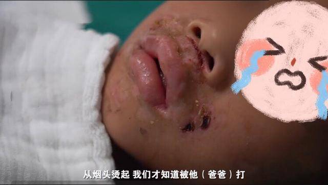 广东7岁男童遭父亲烟头烫伤面临截肢,请问父母资格证能取消吗?