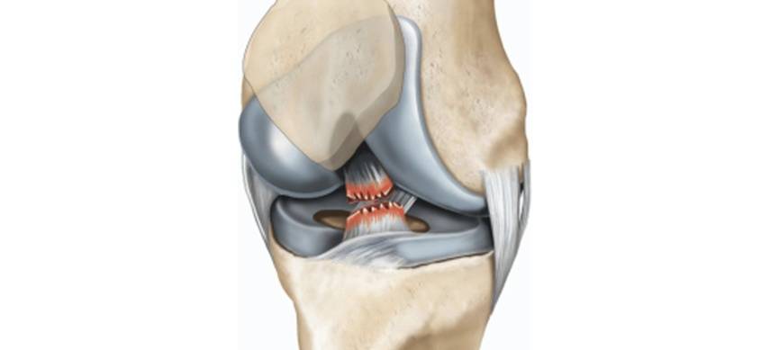 膝关节前交叉韧带 ACL 损伤断裂是个什么病