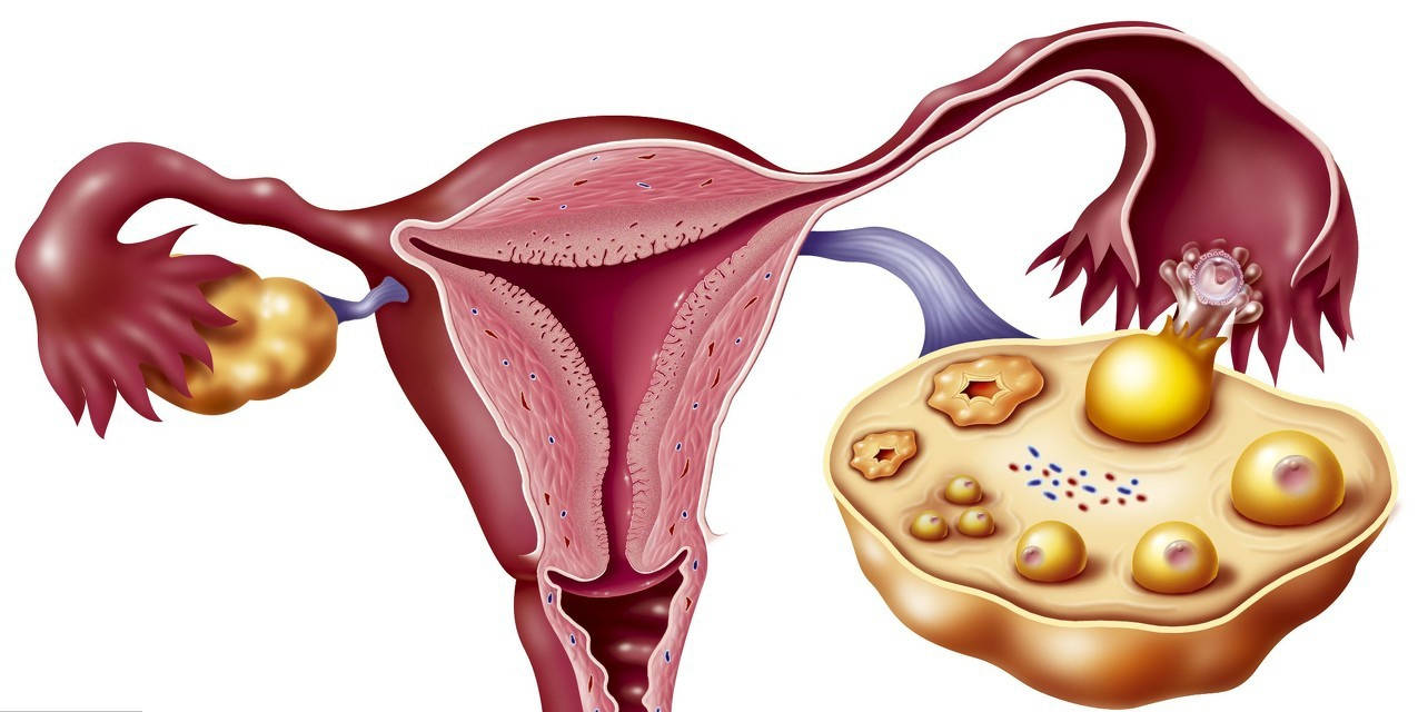 女性患了卵巢囊肿怎么办?作为家人朋友应该注意到以下