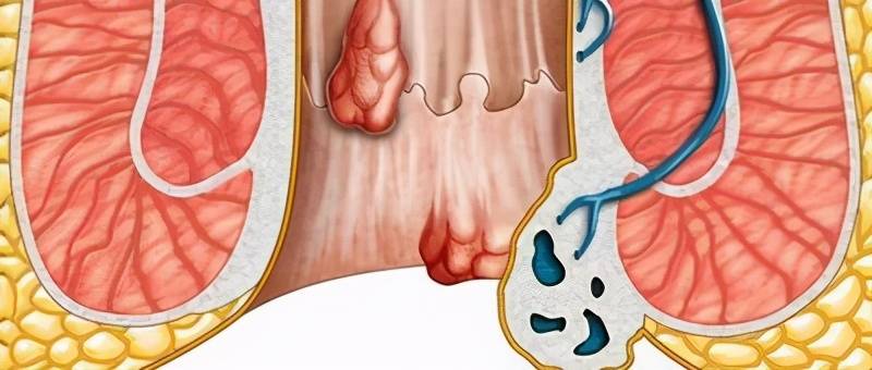屁眼持续疼痛,不一定就是痔疮肛裂,肛管炎了解一下