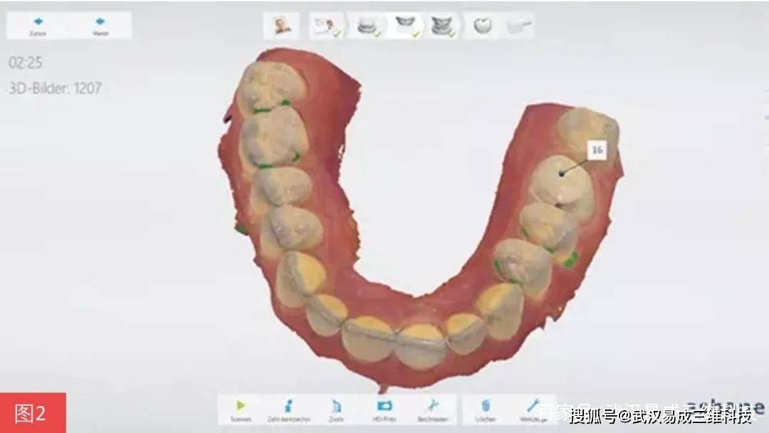 3shape代理分享一站式间接修复的椅旁流程