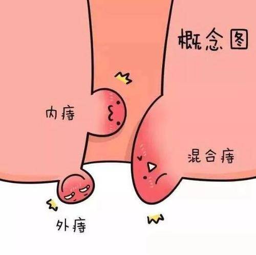 痔疮的发病原因是什么有哪些类型