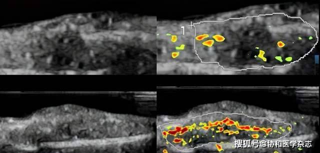 成像|北京协和医院超声医学科杨萌发表于ULTRASOUND MED BIOL的研究