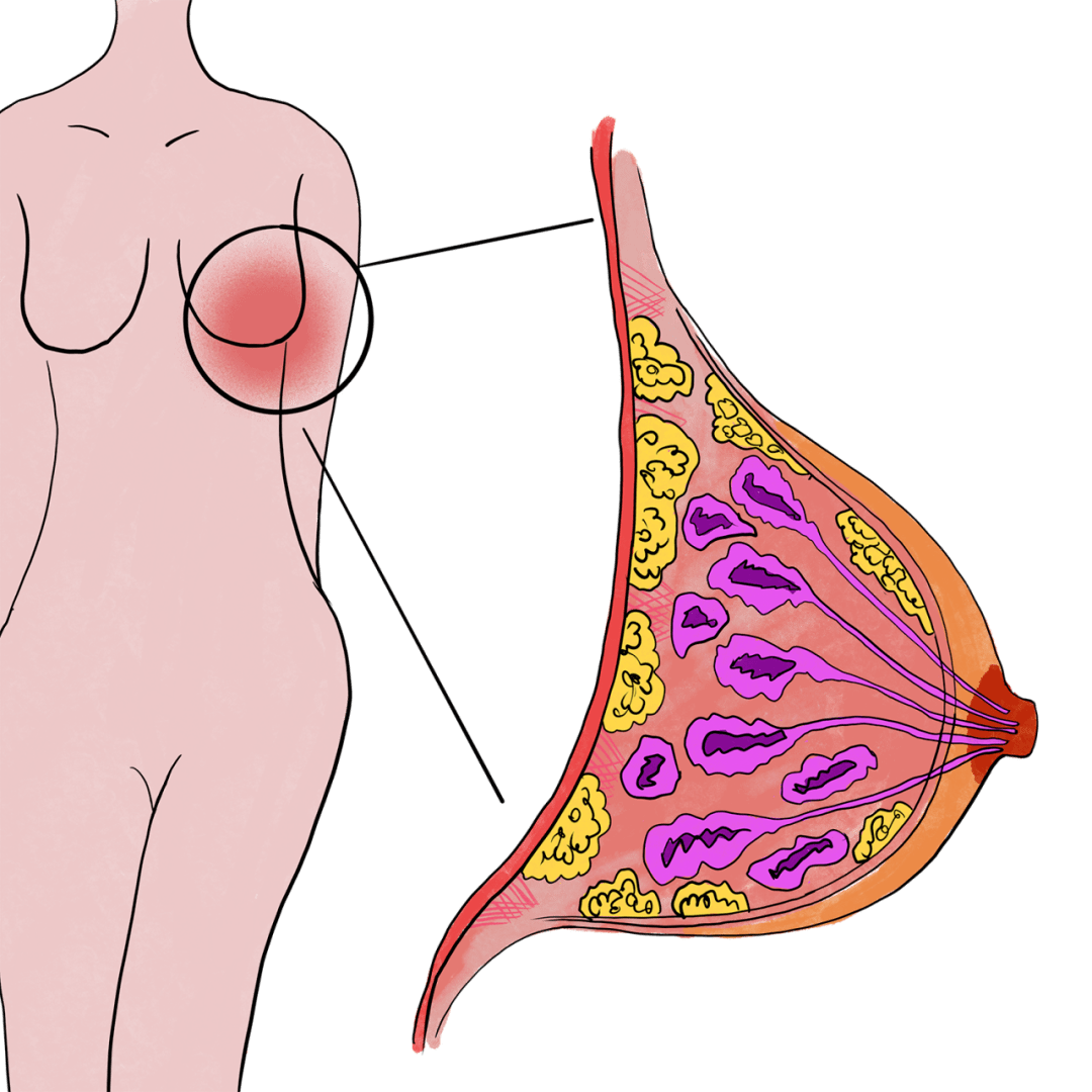 最小的乳腺癌患者仅3岁 医生:乳腺癌可预防_乳房