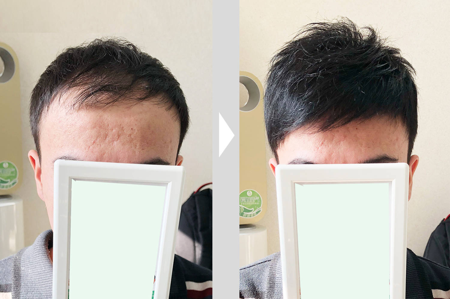 m型发际线怎么改善?