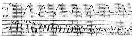 r-on-t现象室性期前收缩诱发心室颤 动