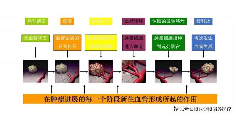 抗血管生成药物是治疗晚期肿瘤的万金油吗?