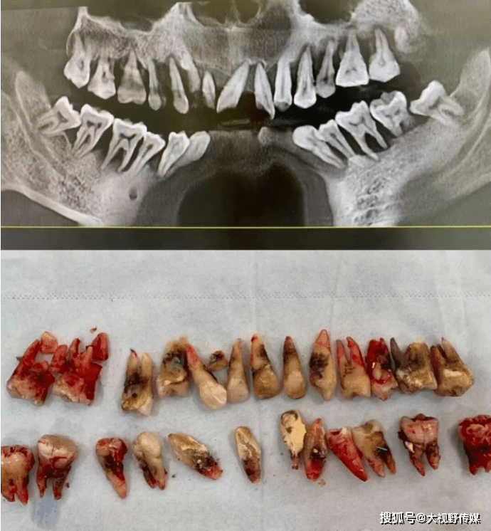26岁女生一口牙拔掉11颗!只因一个疏忽…_牙齿