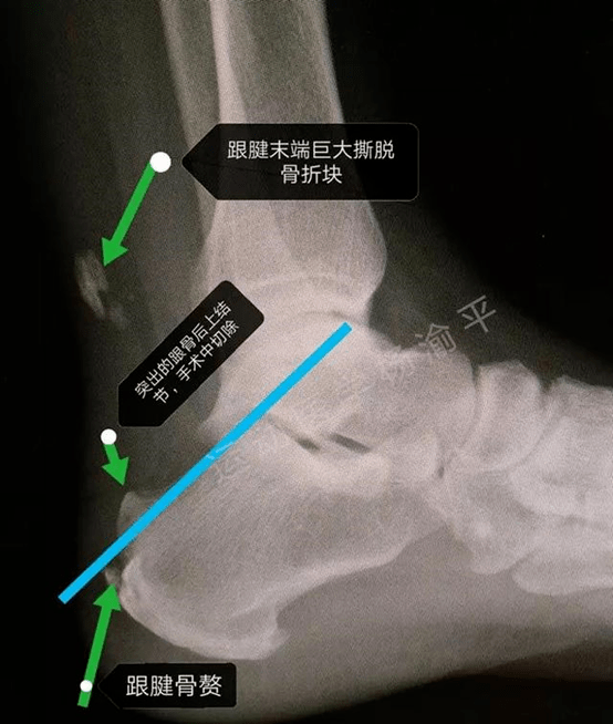 垫脚|足跟酸痛、僵硬？垫脚尖困难？医生教你在家自查跟腱健康状况