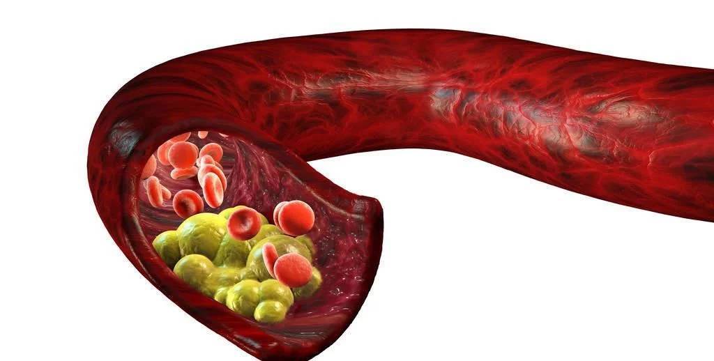 肺鳞癌是什么样的 6363ec7eabcd4ec88c48f08c2d3233f9.jpeg